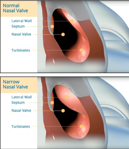 Narrow Nasal valve diagram
